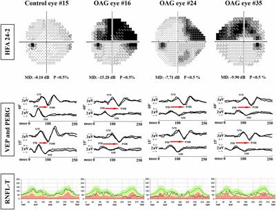 Neural Conduction Along Postretinal Visual Pathways in Glaucoma